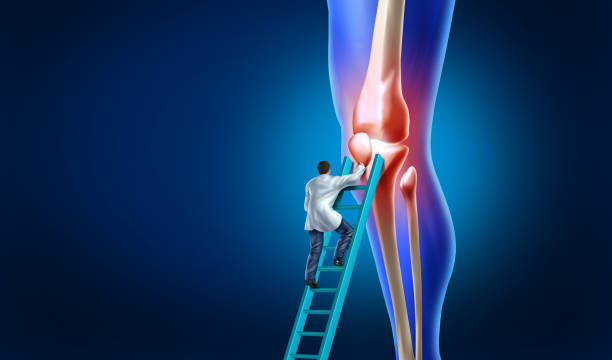 Knee pain care with the anatomy of a skeleton leg and showing the inside inflamation of the painful joint that needs surgery by an orthopedic surgeon and physical therapy by a doctor and therapist with 3D illustration elements.