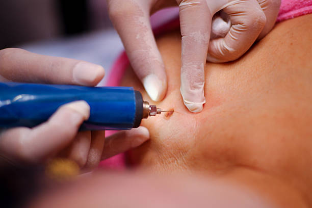 Warts or freckles, doctors, specialists are removing skin diseases with plasma or laser with low electric current, close-up of working in clinic, hospital, beauty salon for customers, beauty career.