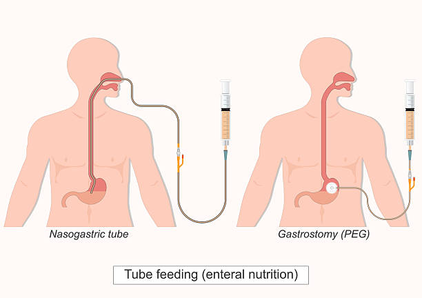 Tube feeding (enteral nutrition) delivers liquid nutrition through a flexible tube that goes in through nose or directly into stomach.Medical health care, vector illustration.